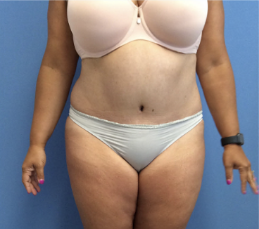 Tummy-Tuck-with-Liposuction--Case-Study-6201 | After Liposuction